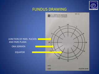 FUNDUS DRAWING
JUNCTION OF PARS PLICATA
AND PARS PLANA
ORA SERRATA
EQUATOR
 