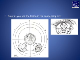 • Draw as you see the lesion in the condensing lens
 