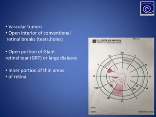 • Vascular tumors
• Open interior of conventional
retinal breaks (tears,holes)
• Open portion of Giant
retinal tear (GRT) or large dialyses
• Inner portion of thin areas
• of retina
 