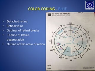 COLOR CODING - BLUE
• Detached retina
• Retinal veins
• Outlines of retinal breaks
• Outline of lattice
degeneration
• Outline of thin areas of retina
 