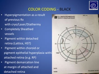 COLOR CODING - BLACK
• Hyperpigmentation as a result
of previous Rx
with cryo/Laser/Diathermy
• Completely Sheathed
vessels
• Pigment within detached
retina (Lattice, HST)
• Pigment within choroid or
pigment epithelial hyperplasia within
attached retina (e.g. RP)
• Pigment demarcation line
at margin of attached and
detached retina
 