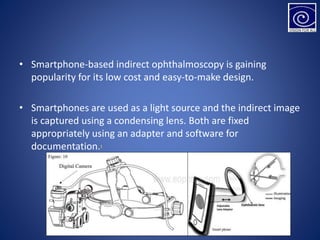 • Smartphone-based indirect ophthalmoscopy is gaining
popularity for its low cost and easy-to-make design.
• Smartphones are used as a light source and the indirect image
is captured using a condensing lens. Both are fixed
appropriately using an adapter and software for
documentation.1
 