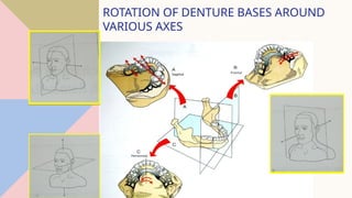 Rotational Rpd Retainer Indirect-Retainers for removable partial denture | PPTX