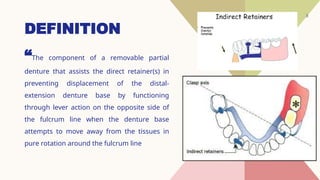 Indiredct Rpd Retainer Indirect-Retainers for removable partial denture | PPTX