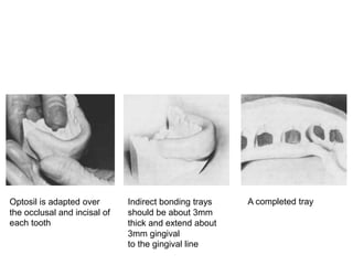 Optosil is adapted over
the occlusal and incisal of
each tooth
Indirect bonding trays
should be about 3mm
thick and extend about
3mm gingival
to the gingival line
A completed tray
 