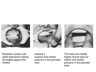 Retraction system with
distal extensions holding
Dri-angles against the
cheeks
exerting a
superior and medial
pressure in the premolar
area
The index and middle
fingers should exert an
inferior and medial
pressure in the premolar
area
 