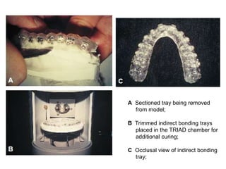 A Sectioned tray being removed
from model;
B Trimmed indirect bonding trays
placed in the TRIAD chamber for
additional curing;
C Occlusal view of indirect bonding
tray;
 