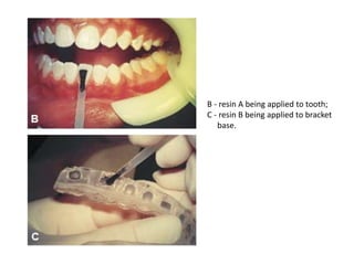 B - resin A being applied to tooth;
C - resin B being applied to bracket
base.
 