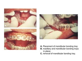 A, Placement of mandibular bonding tray;
B, maxillary and mandibular bonding trays
in place;
C, removal of mandibular bonding tray.
 