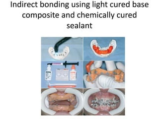 Indirect bonding using light cured base
composite and chemically cured
sealant
 