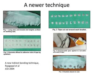 A newer technique
A new Indirect bonding technique,
Rajagopal et al
JCO-2004
 