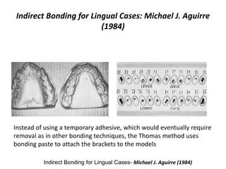 Indirect Bonding for Lingual Cases: Michael J. Aguirre
(1984)
Indirect Bonding for Lingual Cases- Michael J. Aguirre (1984)
Instead of using a temporary adhesive, which would eventually require
removal as in other bonding techniques, the Thomas method uses
bonding paste to attach the brackets to the models
 