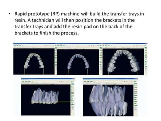 • Rapid prototype (RP) machine will build the transfer trays in
resin. A technician will then position the brackets in the
transfer trays and add the resin pad on the back of the
brackets to finish the process.
 