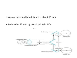 • Normal interpupillary distance is about 60 mm
• Reduced to 15 mm by use of prism in IDO
 