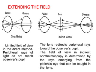 EXTENDING THE FIELD
Limited field of view
in the direct method.
Peripheral rays of
light do not reach
observer's pupil
The lens redirects peripheral rays
toward the observer’s pupil.
The field of view in indirect
ophthalmoscopy is determined by
the rays emerging from the
patient's eye that can be caught in
the lens.
 