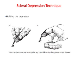 Scleral Depression Technique
• Holding the depressor
 