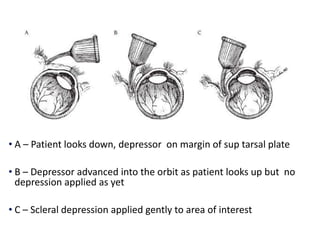 • A – Patient looks down, depressor on margin of sup tarsal plate
• B – Depressor advanced into the orbit as patient looks up but no
depression applied as yet
• C – Scleral depression applied gently to area of interest
 