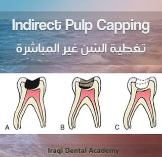 Indirect Pulp Capping Procedure