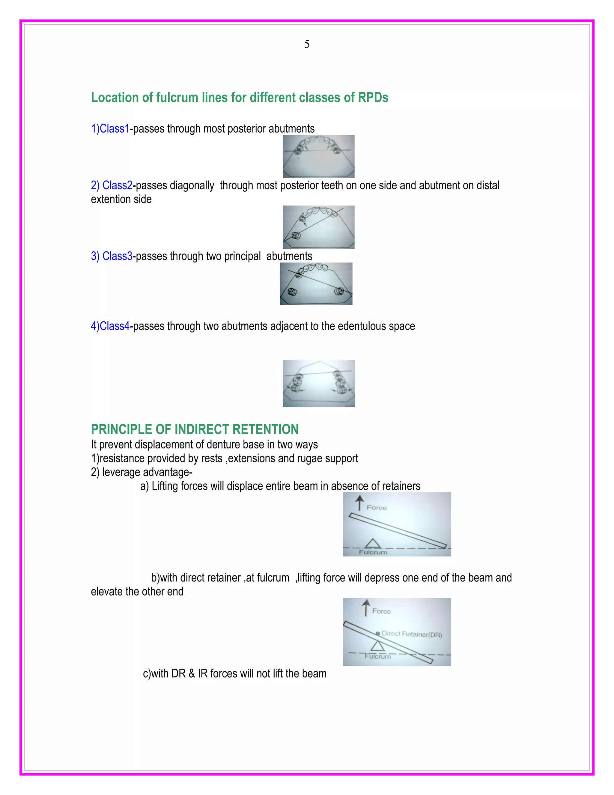 5



Location of fulcrum lines for different classes of RPDs

1)Class1-passes through most posterior abutments



2) Class2-passes diagonally through most posterior teeth on one side and abutment on distal
extention side



3) Class3-passes through two principal abutments




4)Class4-passes through two abutments adjacent to the edentulous space




PRINCIPLE OF INDIRECT RETENTION
It prevent displacement of denture base in two ways
1)resistance provided by rests ,extensions and rugae support
2) leverage advantage-
            a) Lifting forces will displace entire beam in absence of retainers




              b)with direct retainer ,at fulcrum ,lifting force will depress one end of the beam and
elevate the other end




            c)with DR & IR forces will not lift the beam
 