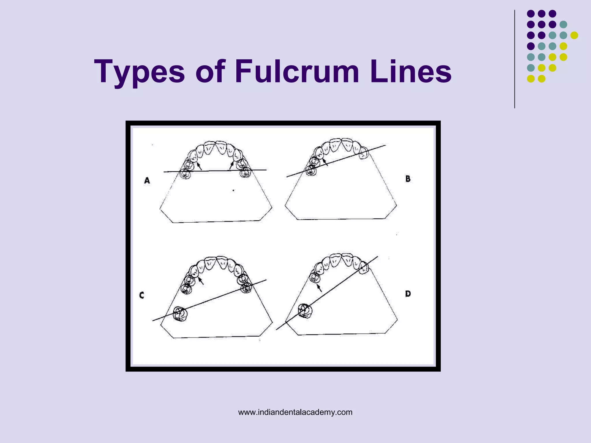 Types of Fulcrum Lines
www.indiandentalacademy.com
 