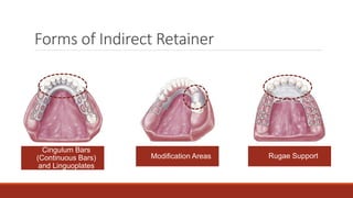 Retainer Casting INDIRECT RETAINERS IN CAST PARTIAL DENTURES | PPTX
