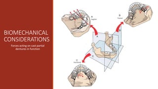 Retainer Casting INDIRECT RETAINERS IN CAST PARTIAL DENTURES | PPTX