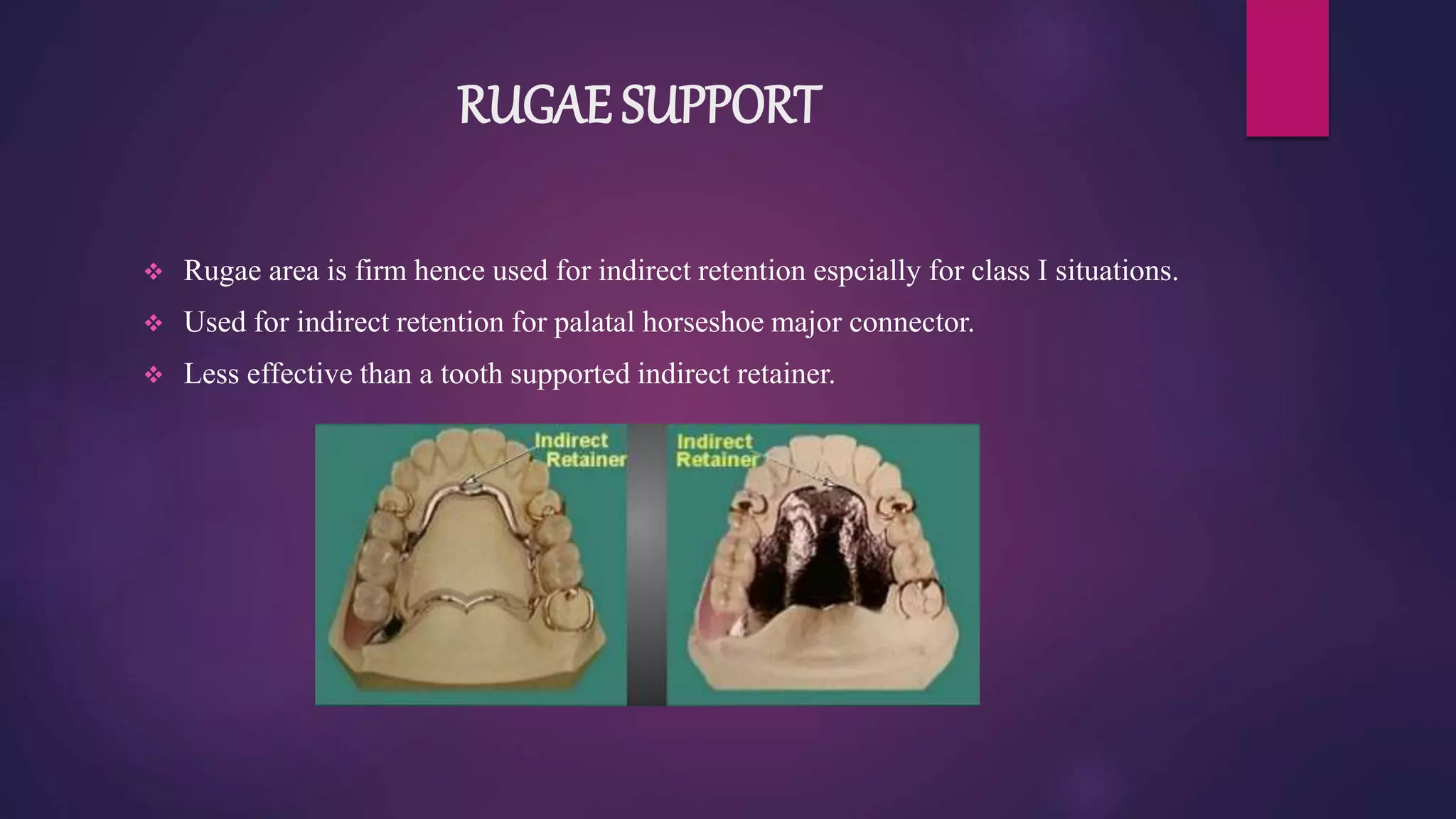 Indiredct Rpd Retainer Indirect retainers | PPTX