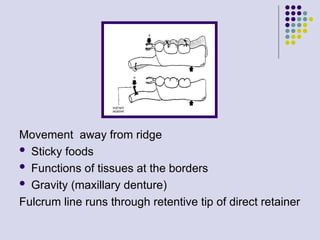 Away From Ridge Indirect Retainers in free saddle cases. | PPT