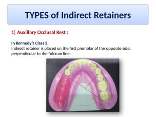 Indiredct Rpd Retainer INDIRECT RETAINERS RPD Dr. Sanket Jadhav | PPTX