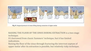 RAISING THE FLOOR OF THE SINUS DURING EXTRACTION is a two-stage
technique.
It’s borrowed from classic Summers’ technique, but it has limited
indications.
Raising the floor of the sinus through fracturing the interroot septum of
upper molar after its extraction is possible, but relatively risky technique.
 