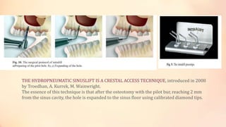THE HYDROPNEUMATIC SINUSLIFT IS A CRESTAL ACCESS TECHNIQUE, introduced in 2008
by Troedhan, A. Kurrek, M. Wainwright.
The essence of this technique is that after the osteotomy with the pilot bur, reaching 2 mm
from the sinus cavity, the hole is expanded to the sinus floor using calibrated diamond tips.
 