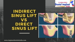 INDIRECT
SINUS LIFT
VS
DIRECT
SINUS LIFT
www.implantdentistindia.com
 