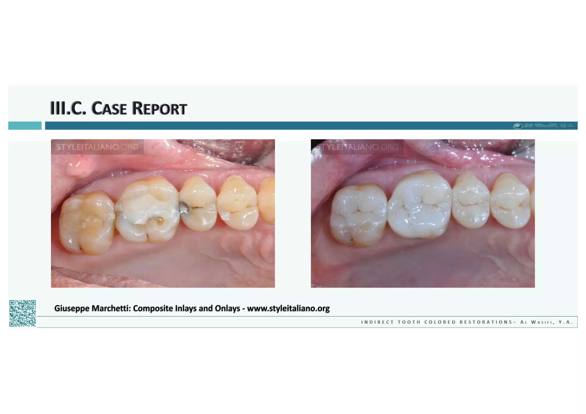 Indirect Tooth Colored Restorations - 2018