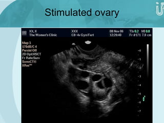 Stimulated ovary 
 