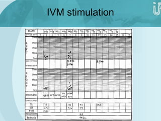 IVM stimulation 
 