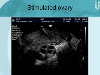 Stimulated ovary 
