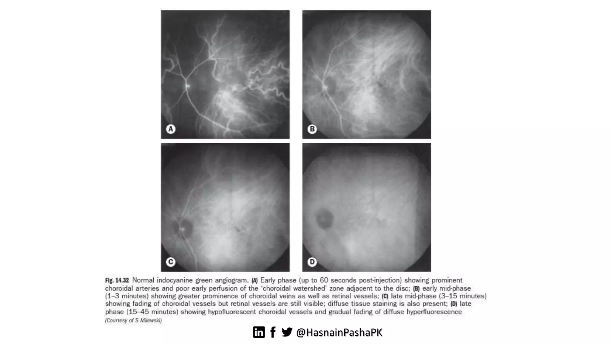 Indocyanine Green Angiography | PPTX