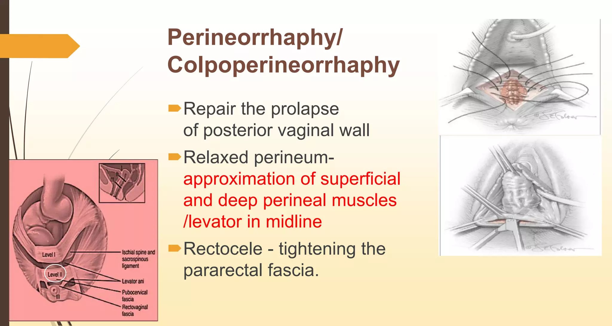 Classification & conservative surgeries for prolapse | PPTX