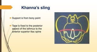 Khanna’s sling
 Support is from bony point
 Tape is fixed to the posterior
aspect of the isthmus to the
anterior superior iliac spine
 