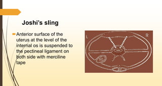 Joshi’s sling
Anterior surface of the
uterus at the level of the
internal os is suspended to
the pectineal ligament on
both side with merciline
tape
 