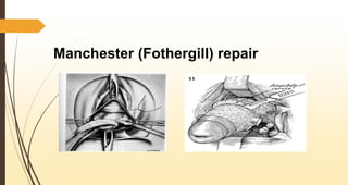 Manchester (Fothergill) repair
 