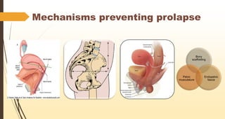 Mechanisms preventing prolapse
Bony
scaffolding
Endopelvic
fascia
Pelvic
musculature
 