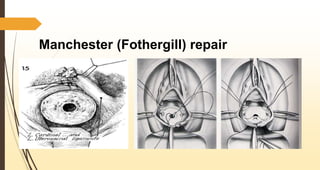 Manchester (Fothergill) repair
 
