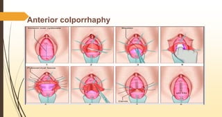 Anterior colporrhaphy
 