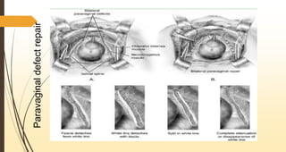 Paravaginaldefectrepair
 