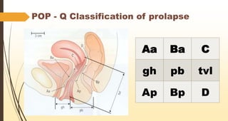 POP - Q Classification of prolapse
Aa Ba C
gh pb tvl
Ap Bp D
 