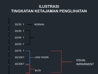 ILUSTRASI
TINGKATAN KETAJAMAN PENGLIHATAN
20/20 f NORMAL
20/30 f
20/40 f
20/50 f
20/70 f
20/100 f LOW VISION
20/200 f
BUTA
VISUAL
IMPAIRMENT
 