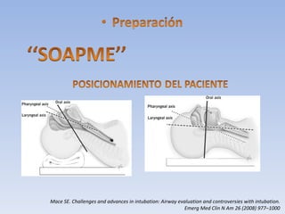 Mace SE. Challenges and advances in intubation: Airway evaluation and controversies with intubation.  Emerg Med Clin N Am 26 (2008) 977–1000 