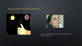 RESULTANTE POSTERO SUPERIOR
Colocar la mandíbula sobre los incisivos inferiores, dejando libre un
espacio libre para ocluir.
 
