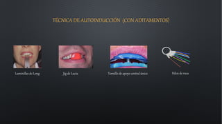 TÉCNICA DE AUTOINDUCCIÓN (CON ADITAMENTOS)
Laminillas de Long Jig de Lucia Tornillo de apoyo central único Hilos de roca
 